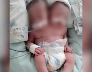Jovem dá à luz a gêmeas siamesas no interior de São Paulo