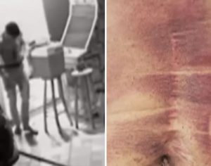 Celular explode e homem fica com queimaduras pelo corpo; assista