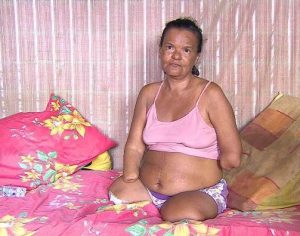 Mulher sem mãos e pernas tem pedido de benefício negado pelo INSS por não poder assinar papel