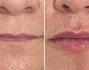 Preenchimento labial: um dos procedimentos mais buscados por brasileiras