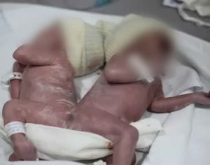 Bebês siameses nascem com união rara em cidade do Paraná